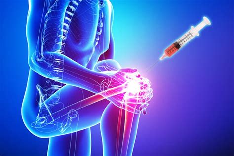 A total of 64 subjects were screened, and 57 subjects. . Prp and stem cell treatment for knee osteoarthritis
